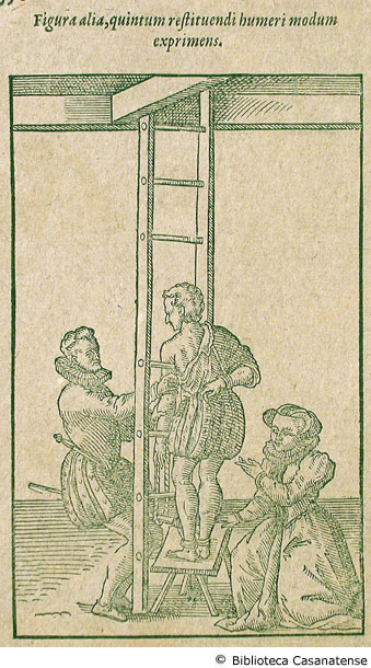 figura alia, quintum restituendi humeri modum exprimens (medico che esegue una trazione), p. 332 (figura a sinistra)